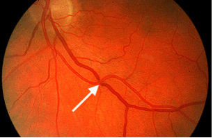 givre-gruppo-italiano-chirurgia-vitreoretinica-glossario-occlusioni-venose-retiniche-001